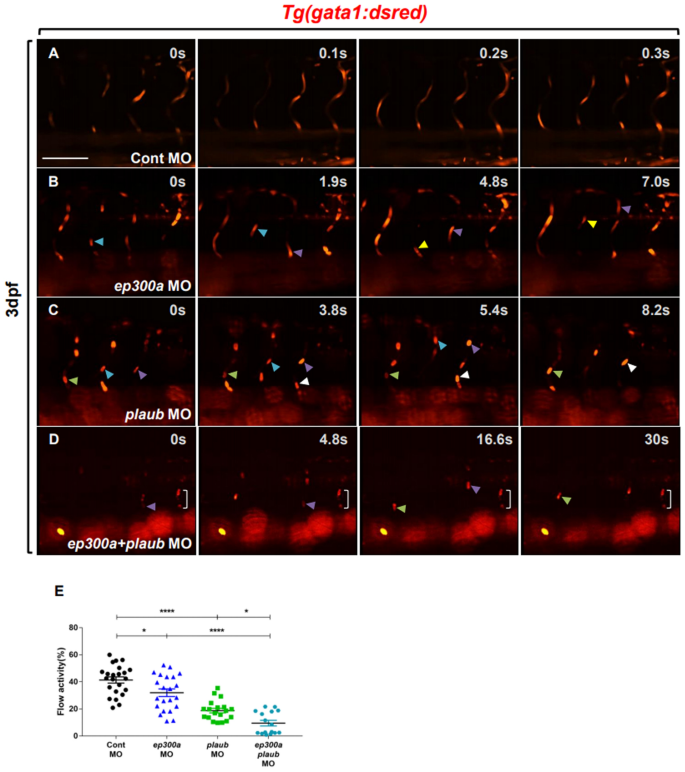 Identification of de novo EP300 and PLAU variants in a patient with  Rubinstein–Taybi syndrome-related arterial vasculopathy and skeletal  anomaly