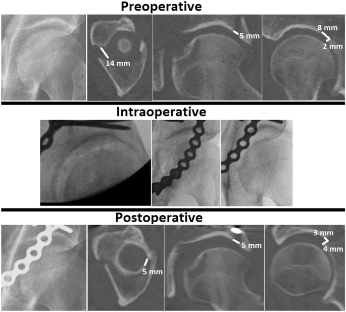 The accuracy of gap and step-off measurements in acetabular fracture  treatment | Scientific Reports