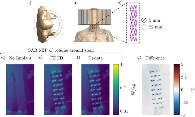 A perturbation approach for ultrafast calculation of RF field enhancements  near medical implants in MRI | Scientific Reports