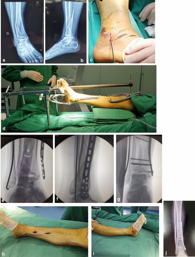 A new surgical strategy for the treatment of tibial pilon fractures with  MIPO facilitated by double reverse traction repositor | Scientific Reports