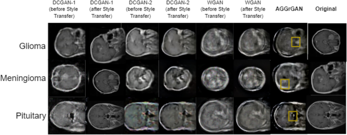 Leveraging Datature Nexus for Tumor and Anomaly Detection in Medical Scans  : Part I