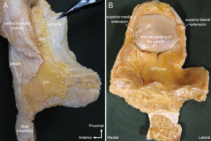 Morphological characteristics of the infrapatellar fat pad | Scientific  Reports