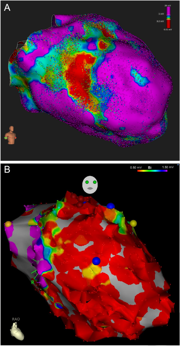 Impact of sex on clinical, procedural characteristics and outcomes of  catheter ablation for ventricular arrhythmias according to underlying heart  disease