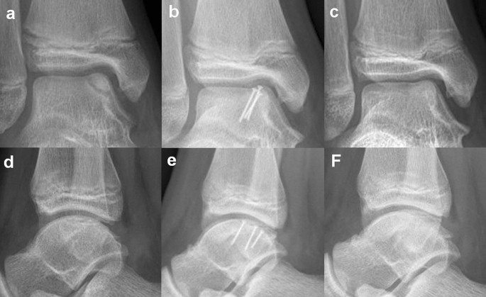 Second-look arthroscopic and magnetic resonance analysis after internal  fixation of osteochondral lesions of the talus | Scientific Reports