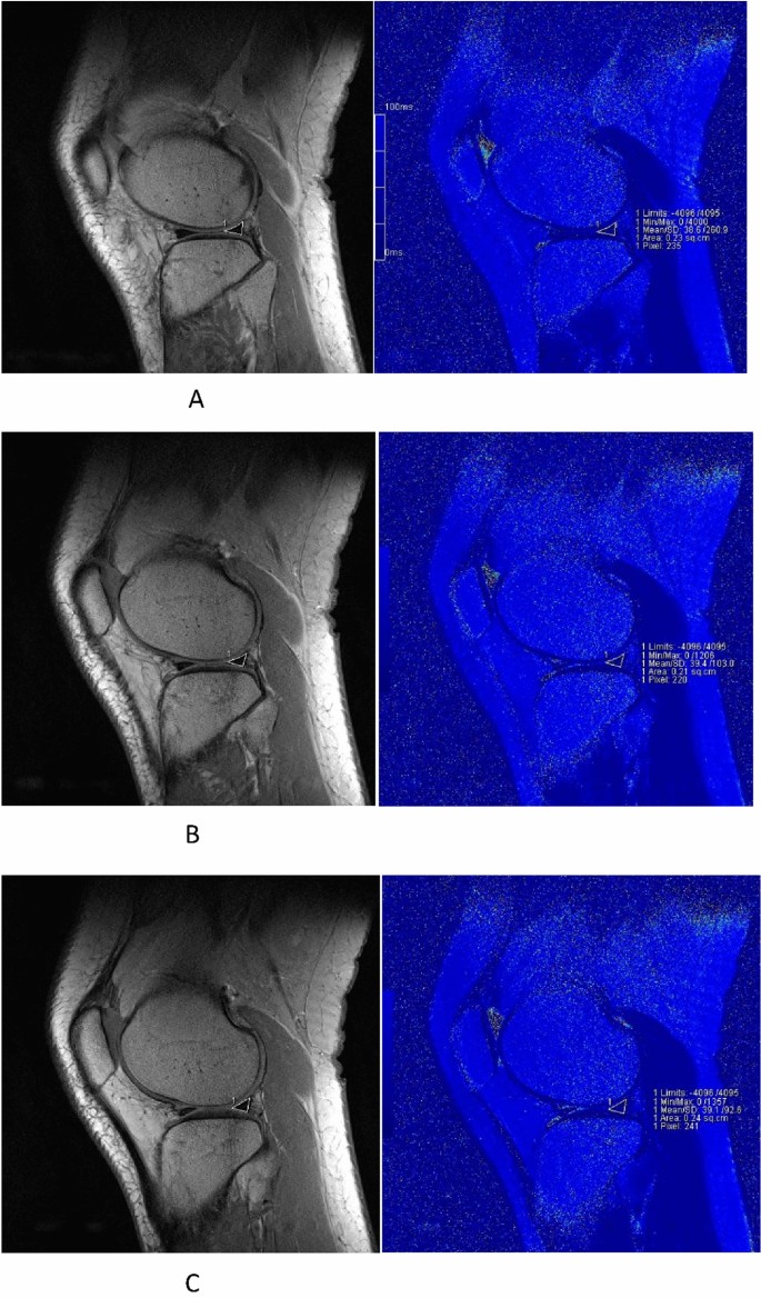 Periodical assessment of four horns of knee meniscus using MR T2 mapping imaging in volunteers before and after amateur marathons Scientific Reports image