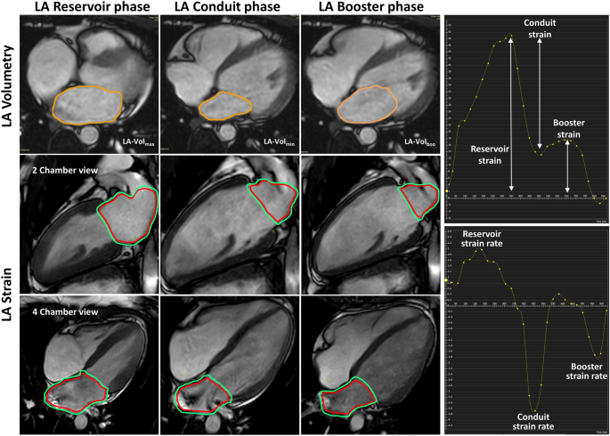 Left Atrial Strain Determinants During the Cardiac Phases