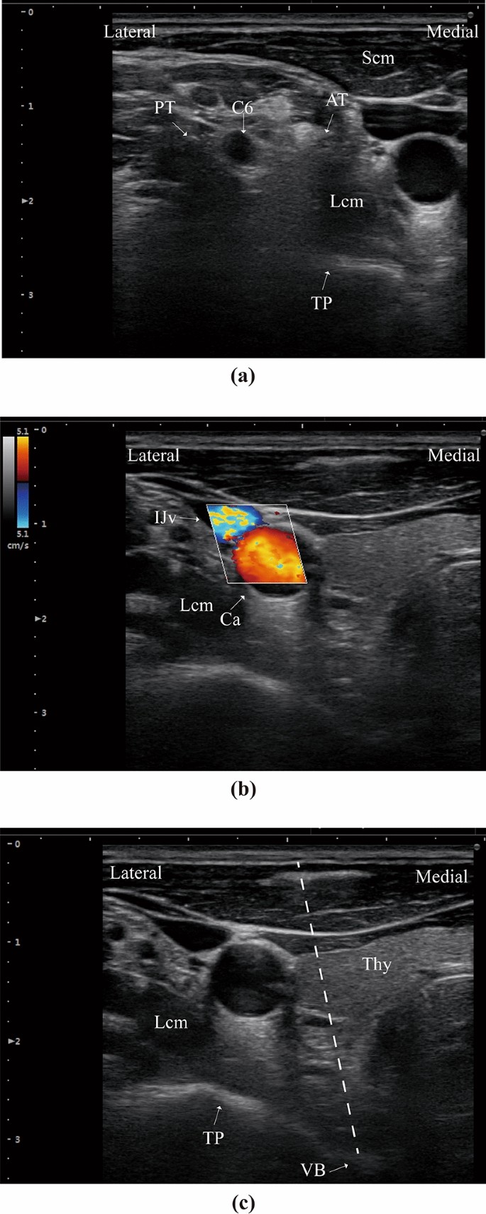 Feasibility study of ultrasound-guided percutaneous laser discectomy for  cervical radicular pain | Scientific Reports