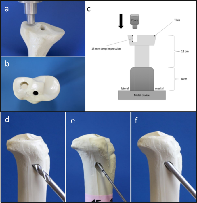 Plate osteosynthesis combined with bone cement provides the