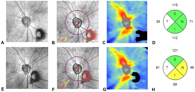 Effect of Weiss ring on peripapillary retinal nerve fiber layer thickness  measurements using SD-OCT | Scientific Reports