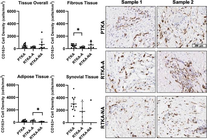 Macrophage cell counts (cells per mm2) in biopsy and tumour resection