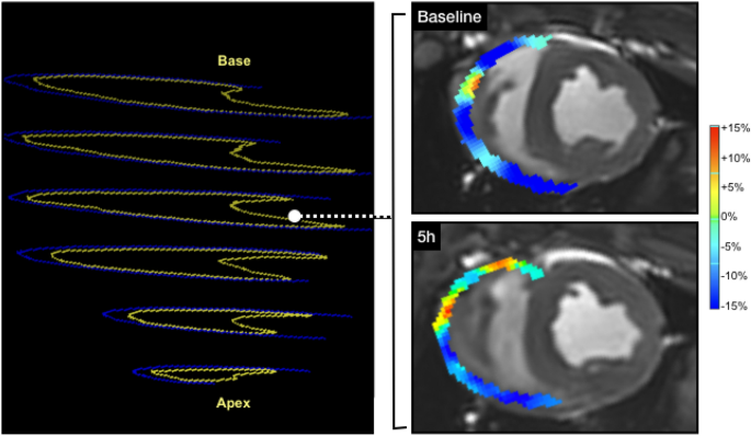 Left Atrial Strain Impairment Precedes Geometric Remodeling as a Marker of  Post-Myocardial Infarction Diastolic Dysfunction - ScienceDirect