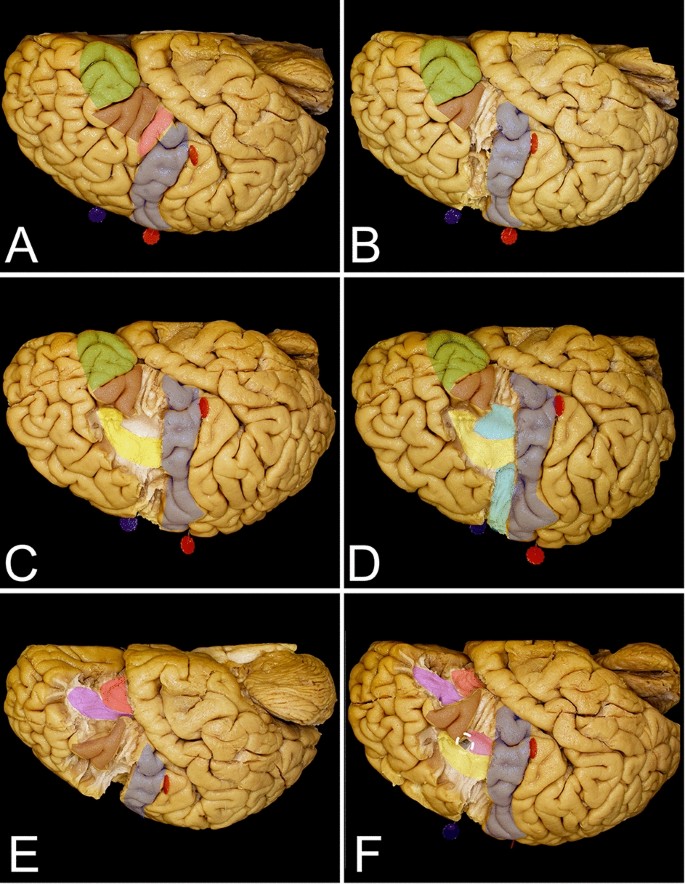 Cortical and white matter anatomy relevant for the lateral and superior  approaches to resect intraaxial lesions within the frontal lobe |  Scientific Reports