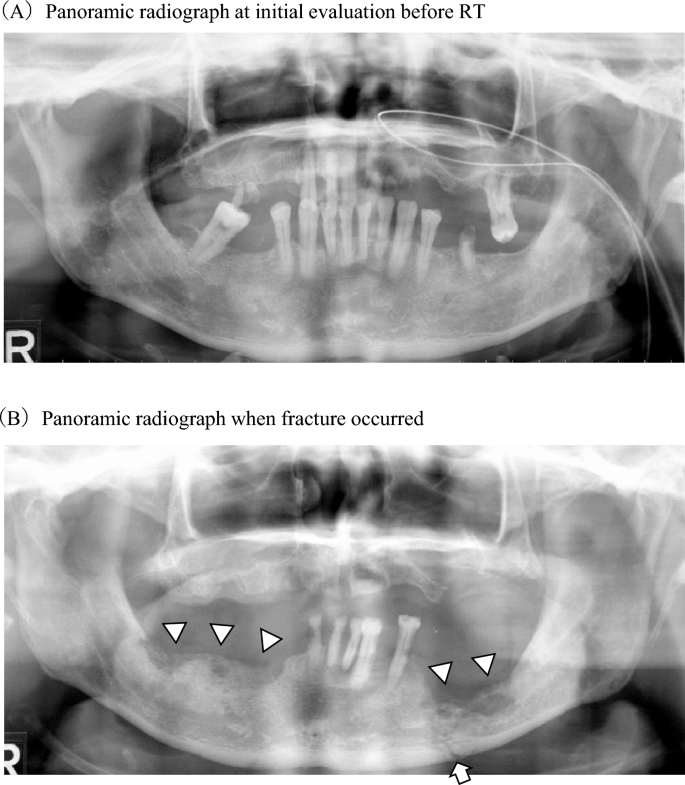 Historical Nonfiction — Pathologic mandibular prognathism, or