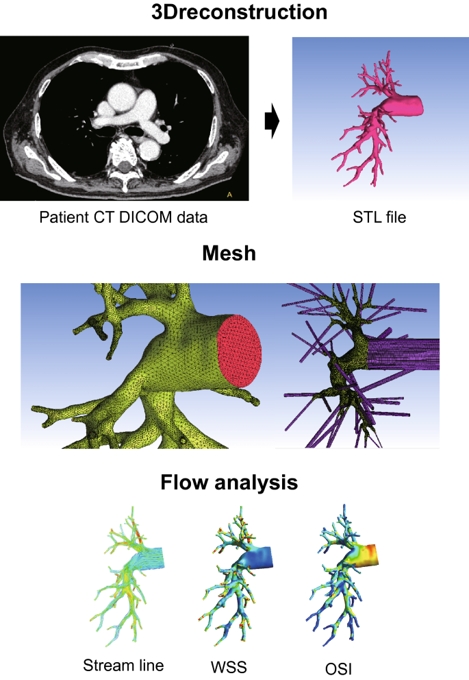 Pulmonary artery blood flow dynamics in chronic thromboembolic 