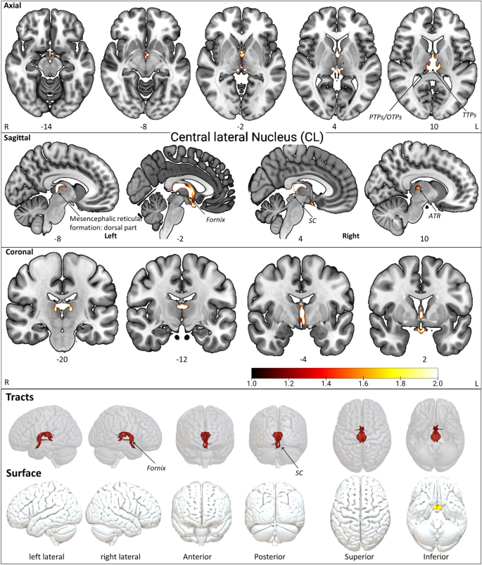 PDF) Tractographical model of the cortico-basal ganglia and corticothalamic  connections: Improving Our Understanding of Deep Brain Stimulation