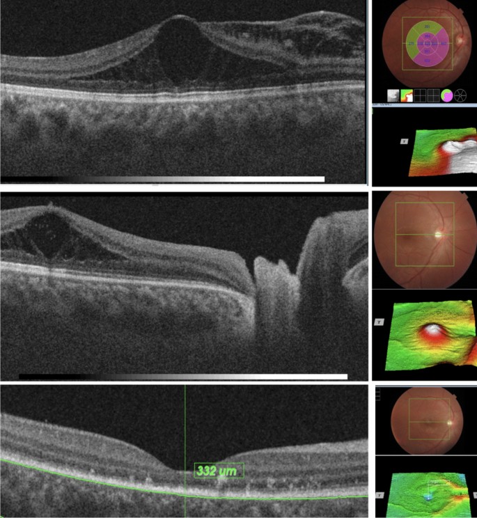 Minimally invasive procedure for optic disc pit maculopathy: vitrectomy  with scleral plug and analysis on pattern of resolution | Scientific Reports