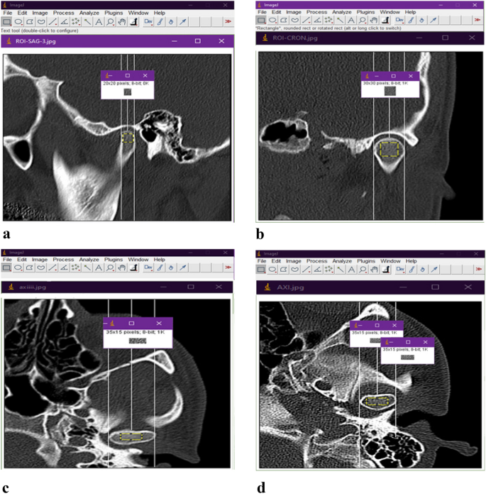 PDF] Evaluation of horizontal condylar angle in malocclusions with  mandibular lateral displacement using cone-beam computed tomography.