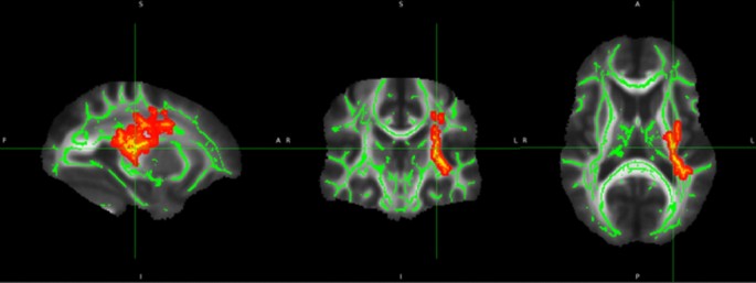 Brain microstructural changes: Another menstrual cycle symptom - The  Gauntlet