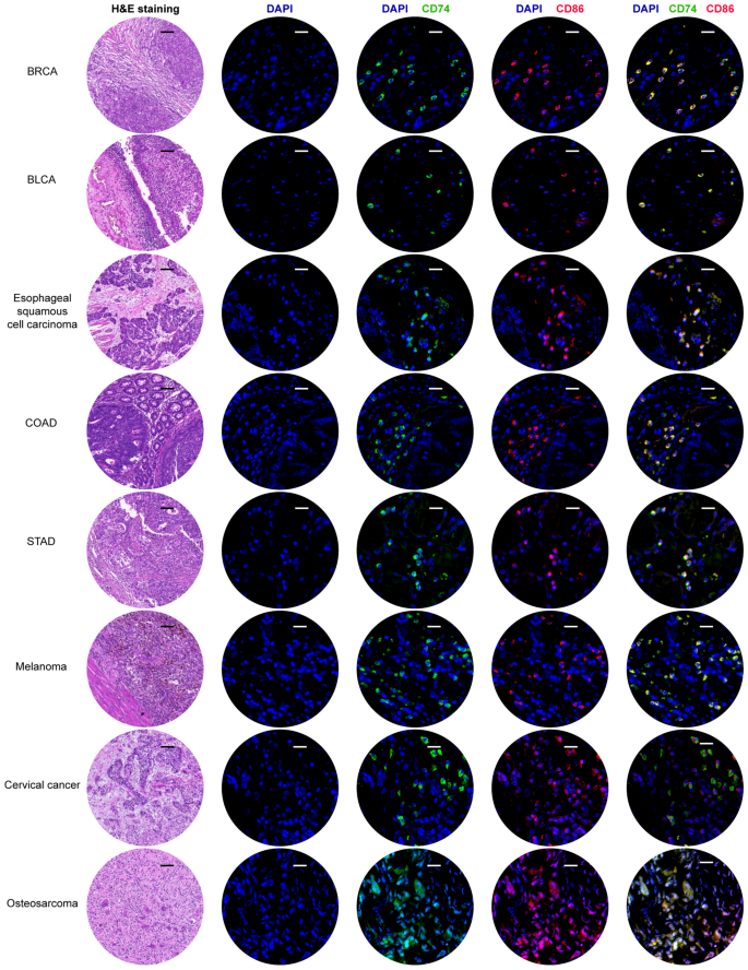 CD74 as a prognostic and M1 macrophage infiltration marker in a