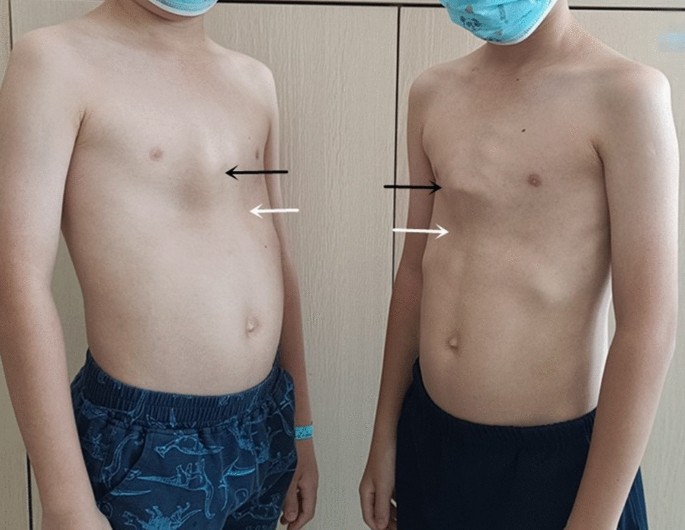 The sandwich technique used for correction of pectus carinatum combined