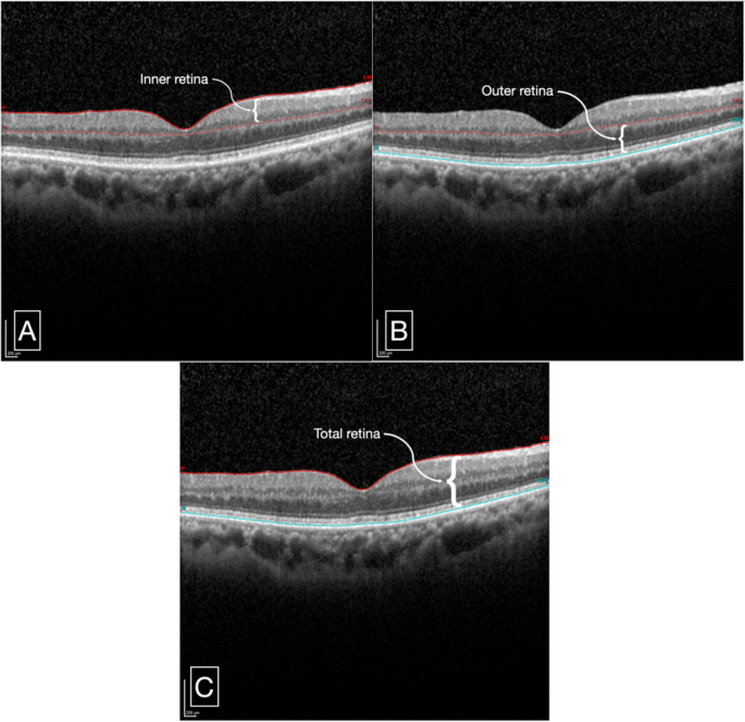 Differences in macular thickness associated with peripheral retinal ...
