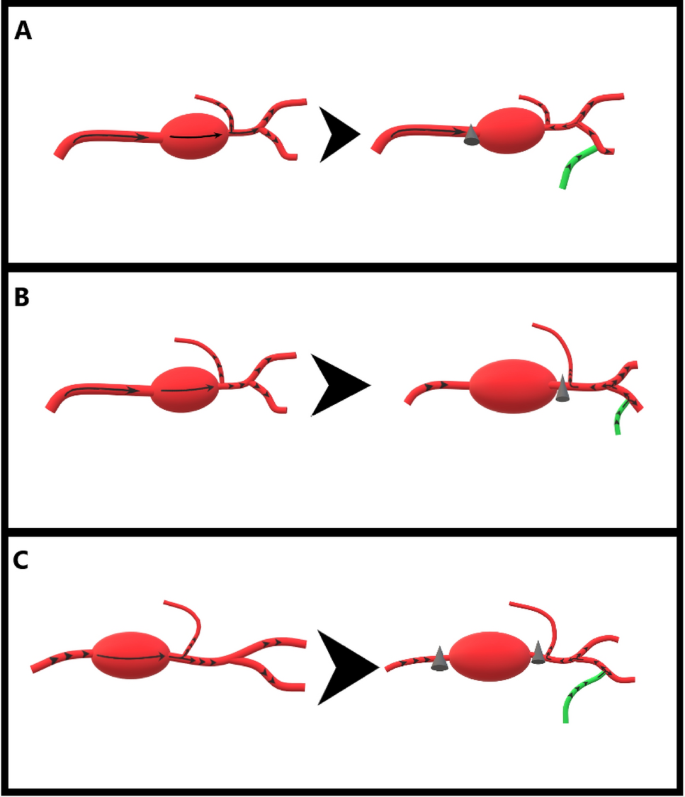 Intracranial bypass for giant aneurysms treatment assessed by ...