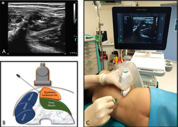 Postoperative analgesic effect of lumbar erector spinae plane block for ...