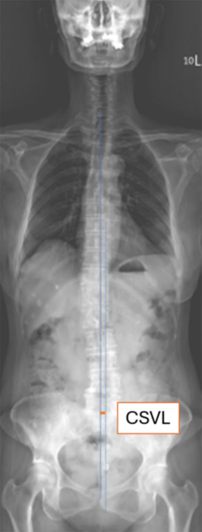 Global tilt angle in spinal alignment of asymptomatic older women with ...