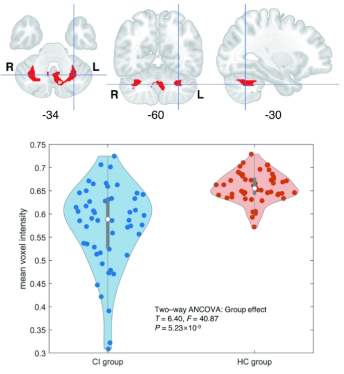 Atrophy of cerebellum Crus I indicates poor outcome of cochlear ...