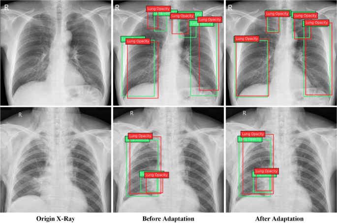 Cross domain lung opacity detection via adversarial learning and  