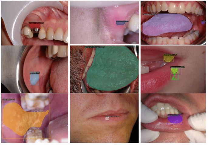 CLASEG: advanced multiclassification and segmentation for differential  diagnosis of oral lesions using deep learning | Scientific Reports