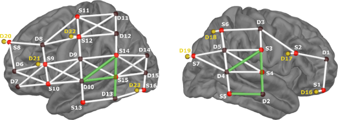 colorful brain scan visualization showing neural activation during speech processing with highlighted auditory pathways