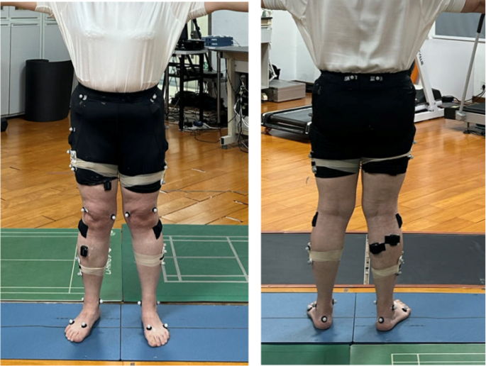 Three-Dimensional gait biomechanics in patients with mild knee ...