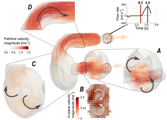 4D flow MRI enhances prototype testing of a total artificial heart ...