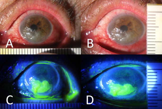 Clinical evaluation of corneal ulcer with a portable and smartphone-attachable slit lamp device: Smart Eye Camera