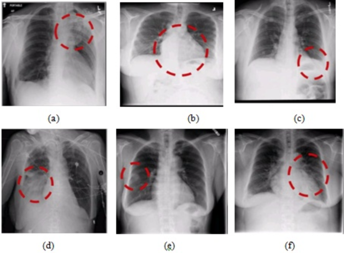 Lung cancer detection with machine learning classifiers with multi ... image.