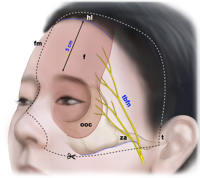 Anatomical consideration for botulinum toxin injection of the frontalis ...