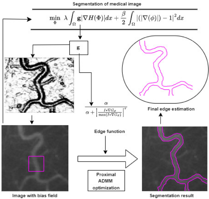 Enhanced medical image segmentation using novel level set evolution and ...