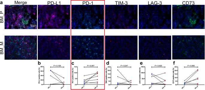Fig. 6: Five immune checkpoints expression heterogeneity in tumor stroma of primary lesions and BM.