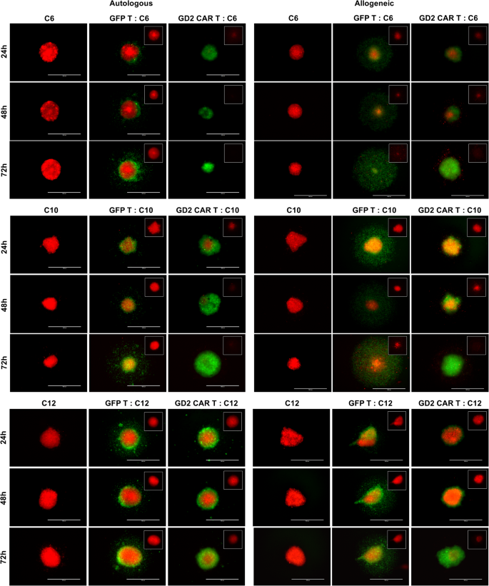 Fig. 3: Comparison of autologous versus allogeneic CAR T cells and controls targeting GBM spheroids.