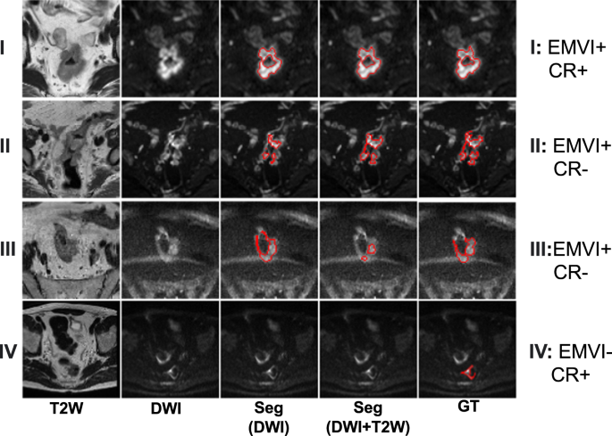 Fig. 3: The visualization of four predicted segmentation from the external cohort.