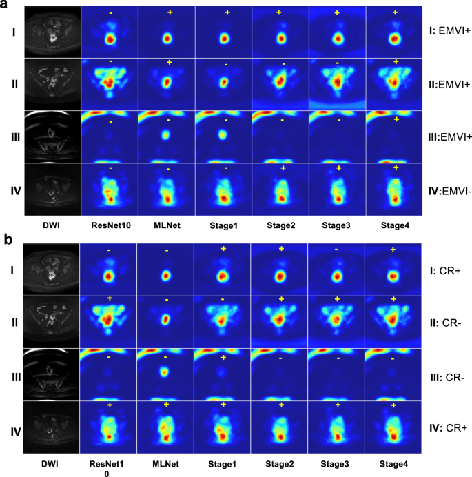 Fig. 7: The visualization based on the Grad-CAM + + method of ablation studies for EMVI classification and CR prediction.