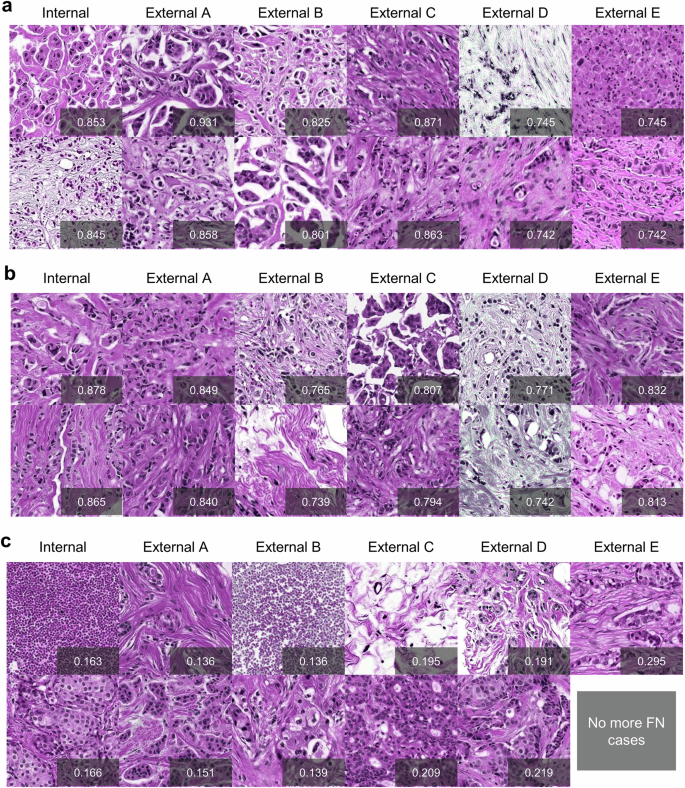 Fig. 3: Examples of PathDL predictions, illustrating the patches with the highest attention scores in each slices, and their corresponding prediction probabilities.