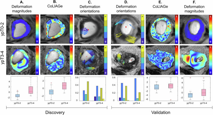 Fig. 1: Representative visualizations for StODeO and texture radiomic descriptors between ypT0-2 (top row) and ypT3-4 (bottom row) rectal cancer patients after therapy across discovery (left half) and validation (right half) cohorts.