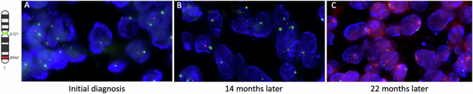 Fig. 2: BRAF amplification was assessed using FFPE interphase FISH.