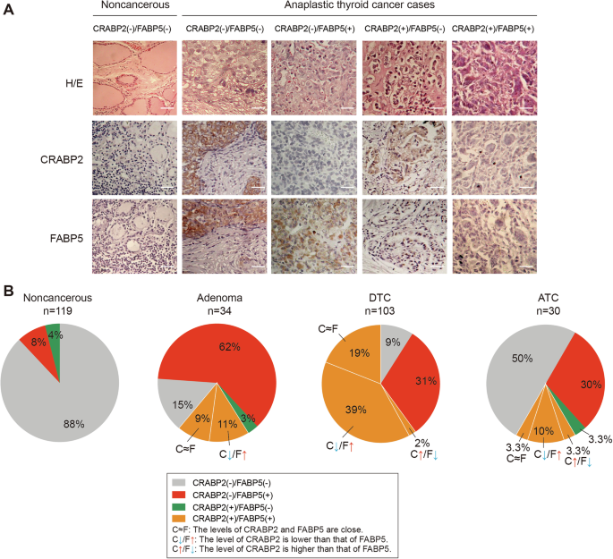Fig. 8: Tissue microarray-based immunohistochemical profiling of CRABP2 and FABP5 expression patterns in noncancerous and ATC tissues.