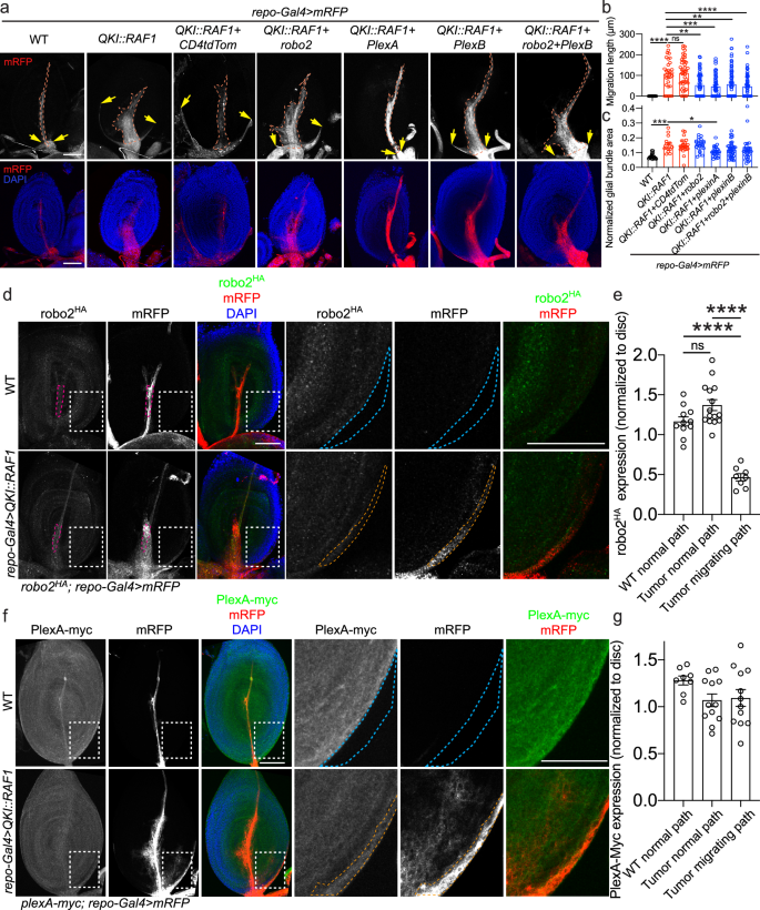 Fig. 3: Robo2 and PlexA/B rescue glial migration defects in QKI::RAF1 glioma model and their expression.