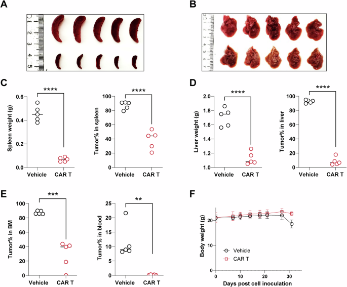 Fig. 5: Anti-CD19 CAR T-cell therapy was validated as an alternative treatment option for MCL patient 17.