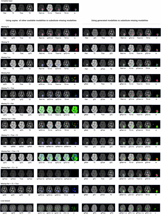 Fig. 5: Examples of segmentation masks in sequence-missing and cross-center scenarios in the BraTS2019 dataset.