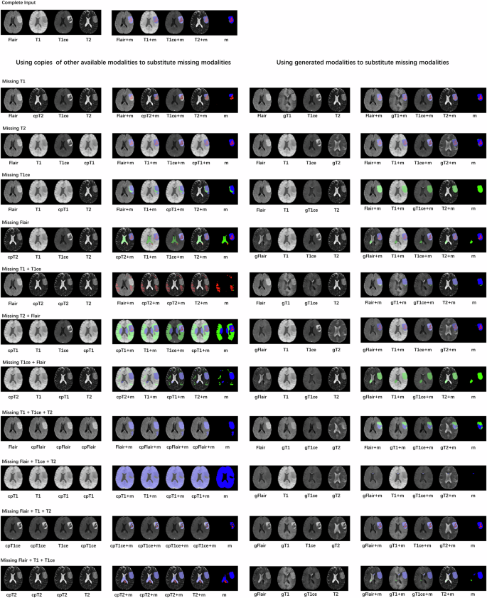 Fig. 6: Examples of segmentation masks in sequence-missing scenarios for meningiomas from the BraTS 2023-MEN dataset.